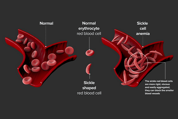 Sickle cell disease